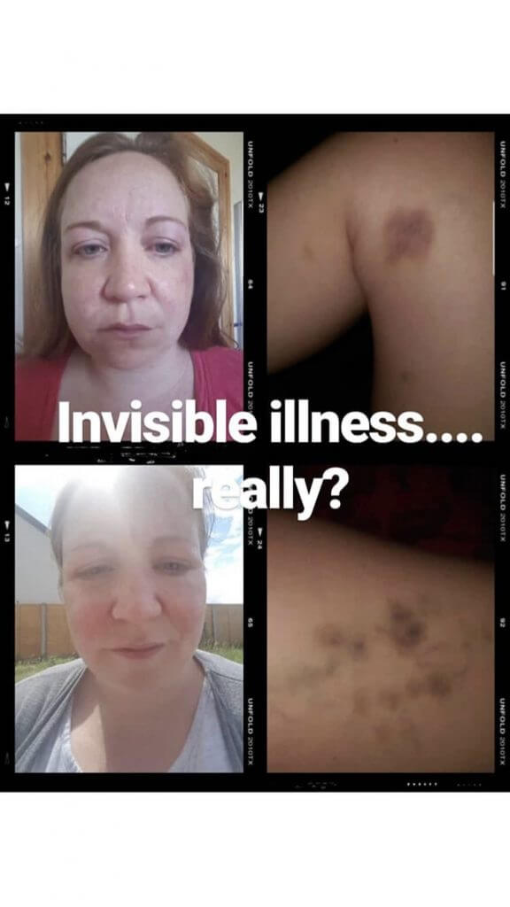 girl sick with lyme disease