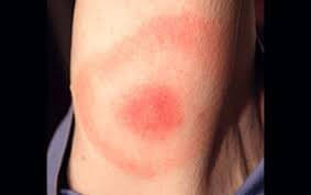 Bullseye rash lyme disease